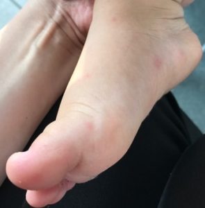 手足口病の足